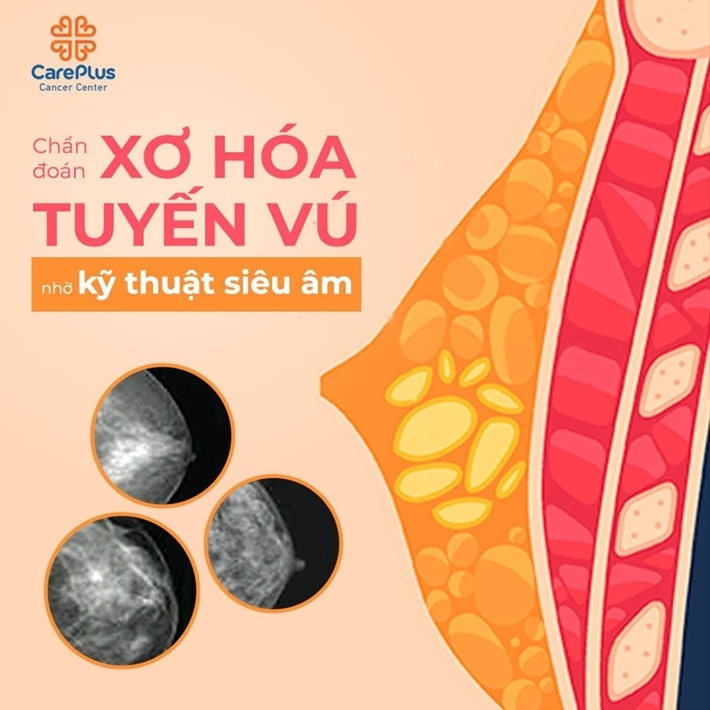 Chẩn đoán xơ nang tuyến vú bằng kỹ thuật nào?