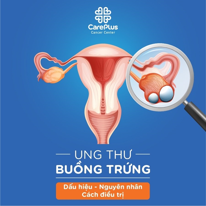 Ung thư buồng trứng: Dấu hiệu, nguyên nhân và cách điều trị 