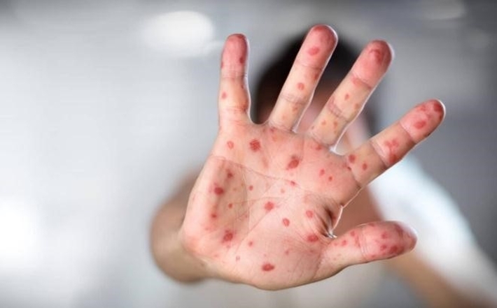 Hand, foot, and mouth disease (HFMD): Symptoms and treatment