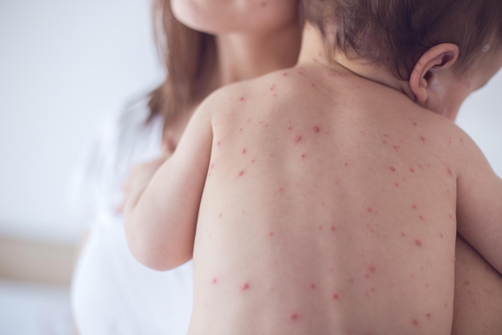 Chickenpox: Signs of Identification and Treatment Fast