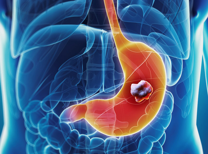 What is stomach cancer? Early symptoms and treatment?