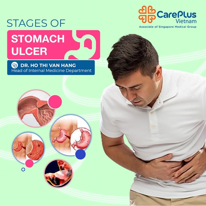 Stages of stomach ulcers