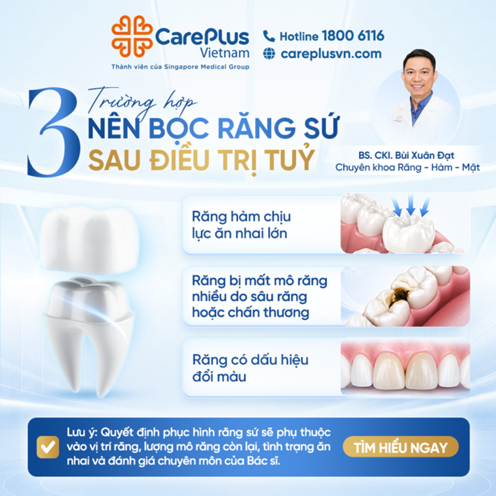 🦷 3 TRƯỜNG HỢP NÊN BỌC RĂNG SỨ SAU ĐIỀU TRỊ TỦY  