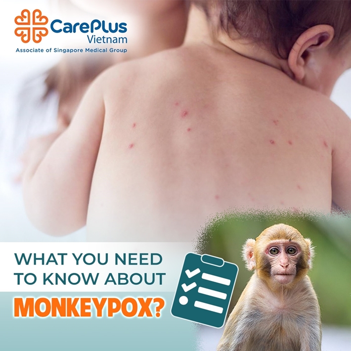 What you need to know about monkeypox?