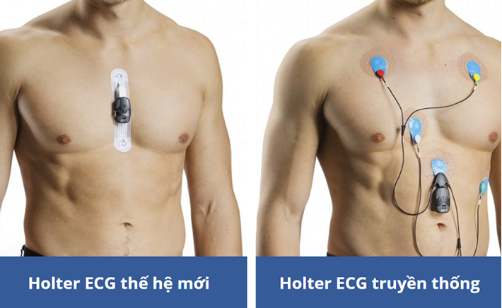 ECG là gì? Những ưu điểm tuyệt vời của Holter ECG thế hệ mới