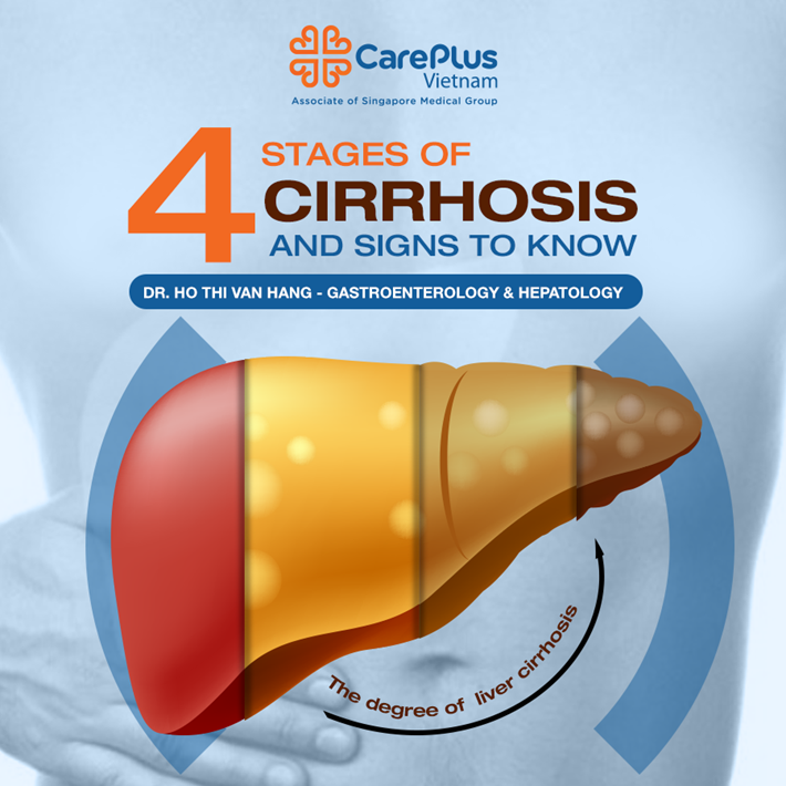 4 Stages of cirrhosis and sign to know