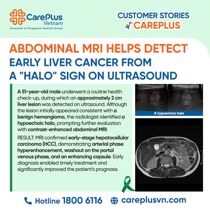 THE "HALO" SIGN ON ULTRASOUND – WHEN MRI BECOMES ESSENTIAL TO UNCOVER EARLY LIVER CANCER