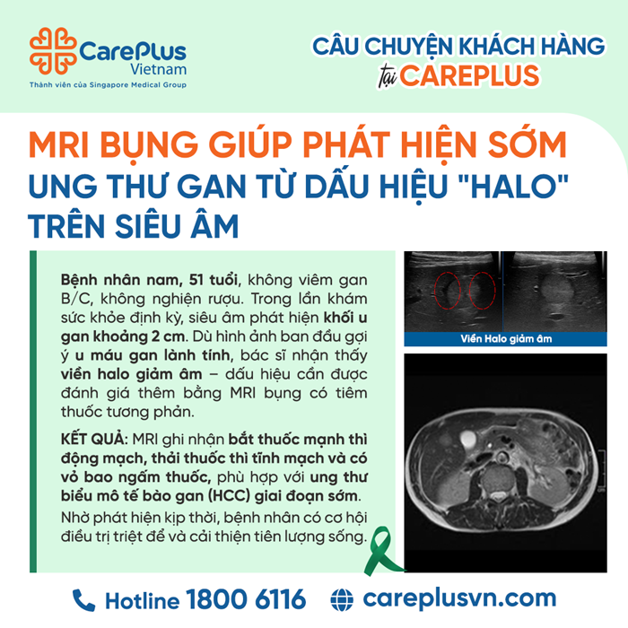 DẤU HIỆU "HALO" TRÊN SIÊU ÂM – KHI CÔNG CỤ TẦM SOÁT CẦN SỰ ĐỒNG HÀNH CỦA MRI ĐỂ "VẠCH TRẦN" UNG THƯ GAN SỚM 