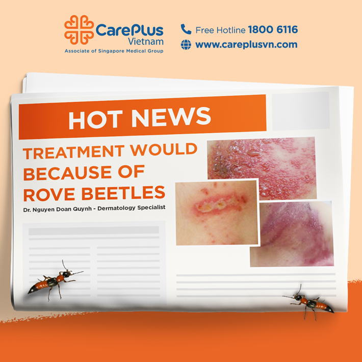 TREATMENT WOULD BECAUSE OF ROVE BEETLES 