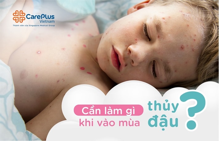 Cần Làm Gì Khi Vào Mùa Thủy Đậu? 