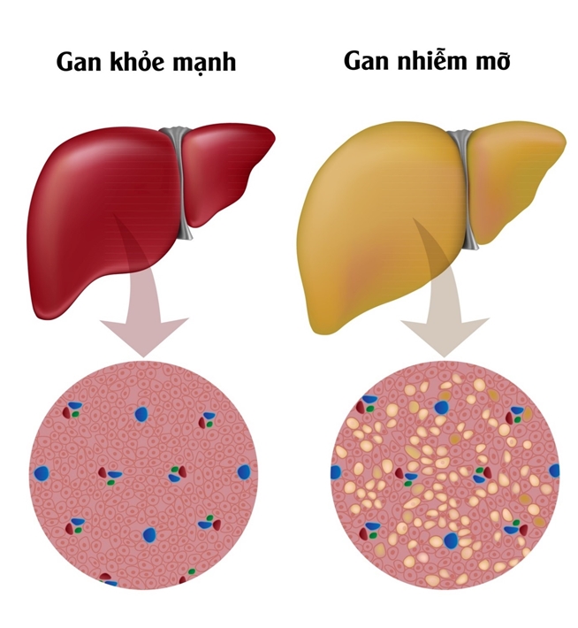 Gan nhiễm mỡ: dấu hiệu nhận biết sớm nhất và cách điều trị