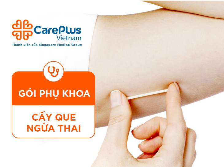 Cấy Que Ngừa Thai