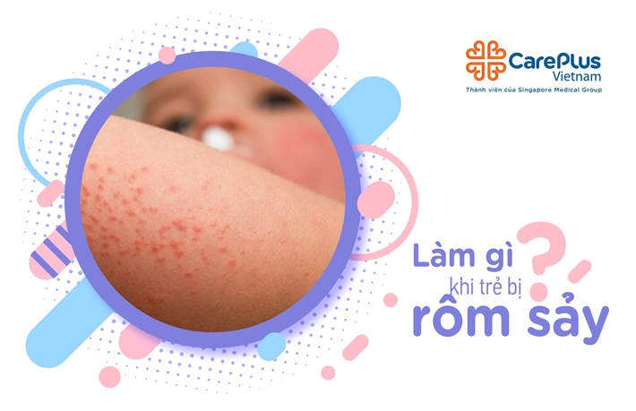 Làm Gì Khi Trẻ Bị Rôm Sảy