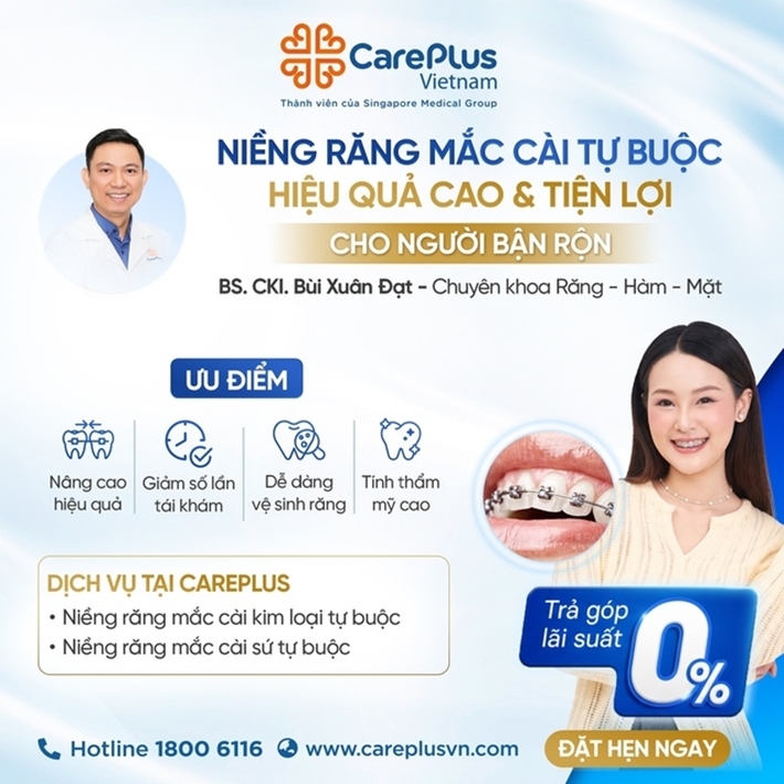 NIỀNG RĂNG MẮC CÀI TỰ BUỘC – HIỆU QUẢ VÀ TIỆN LỢI CHO NGƯỜI BẬN RỘN 
