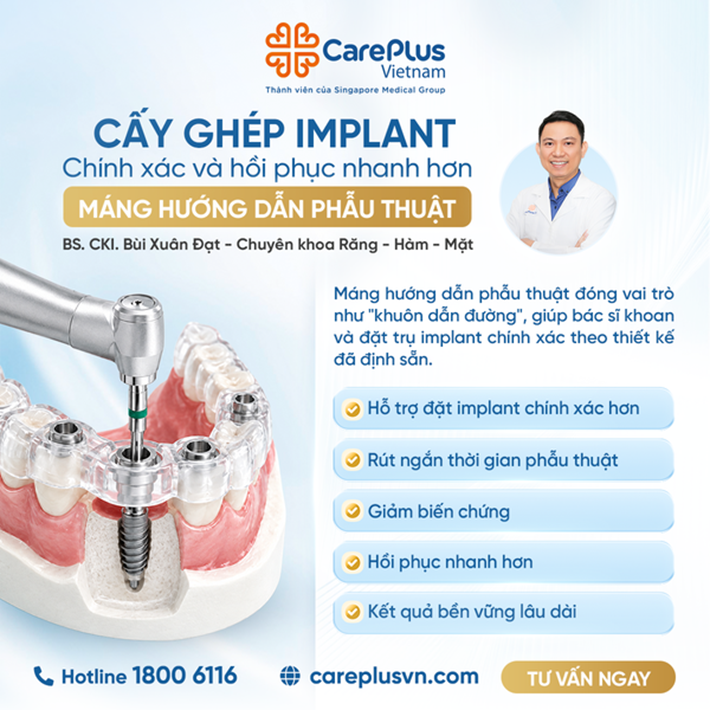 CẤY GHÉP IMPLANT CHÍNH XÁC VÀ HỒI PHỤC NHANH HƠN NHỜ MÁNG HƯỚNG DẪN PHẪU THUẬT 