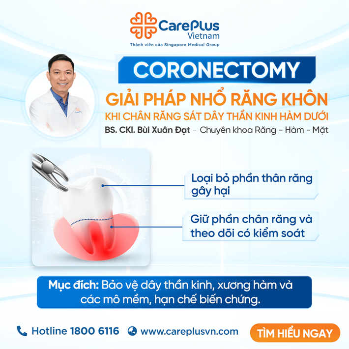 CORONECTOMY: GIẢI PHÁP NHỔ RĂNG KHÔN AN TOÀN KHI CHÂN RĂNG QUÁ SÁT DÂY THẦN KINH HÀM DƯỚI 