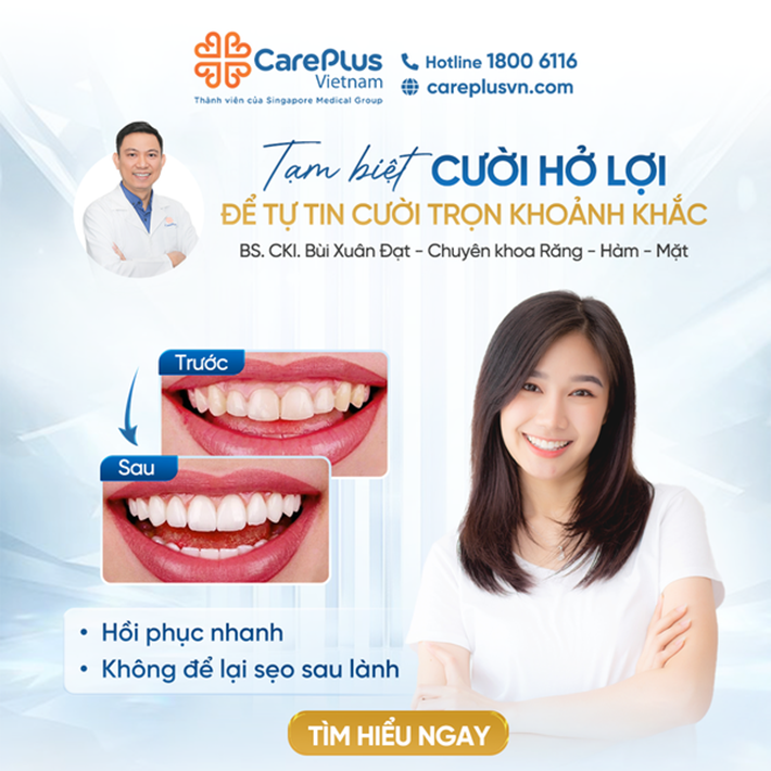 TẠM BIỆT CƯỜI HỞ LỢI - ĐỂ TỰ TIN CƯỜI TRỌN KHOẢNH KHẮC 