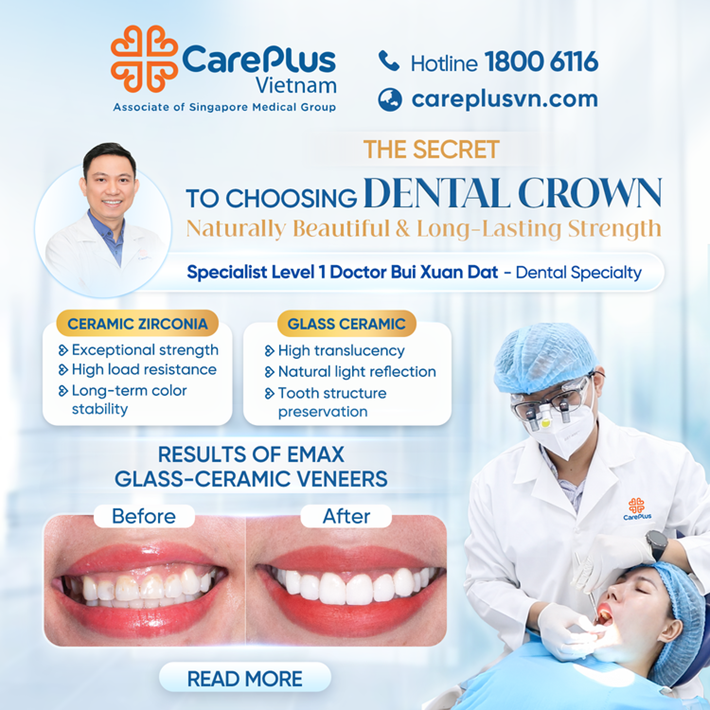 THE SECRET TO CHOOSING DENTAL CROWN - NATURALLY BEAUTIFUL & LONG-LASTING STRENGTH 