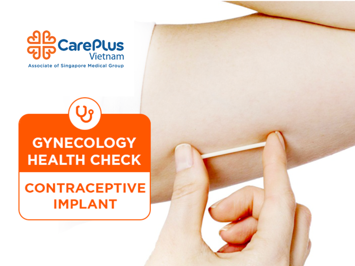 Contraceptive Implant