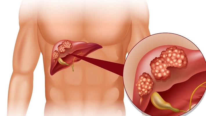 Hepatitis: the earliest symptoms, diagnosis and treatment