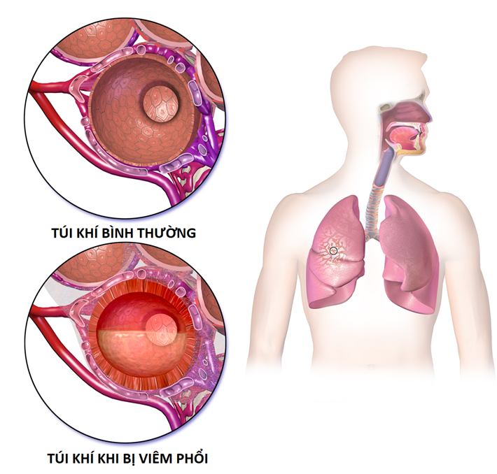 Pneumonia - The leading cause of death in children