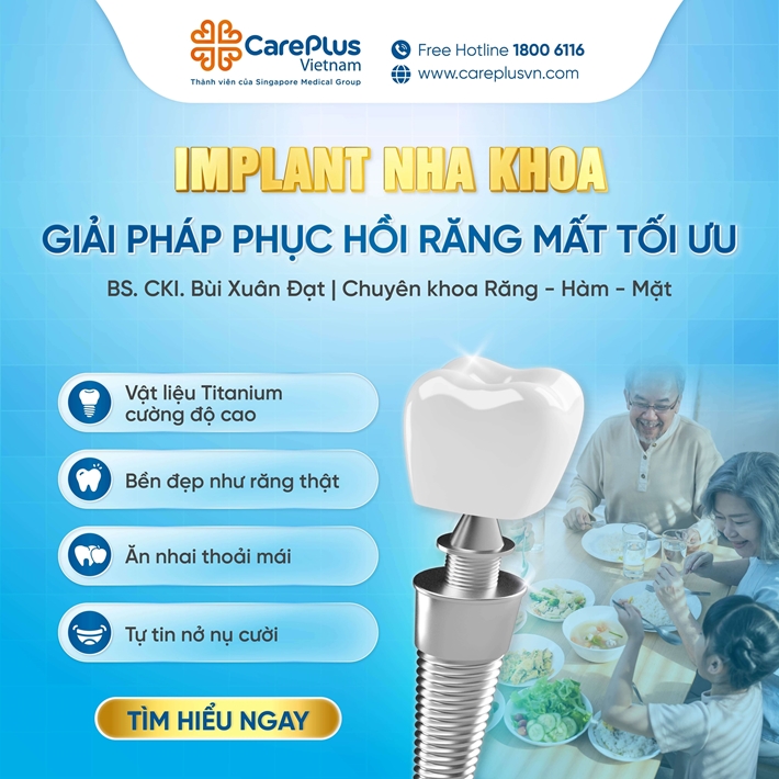 IMPLANT NHA KHOA – GIẢI PHÁP PHỤC HỒI RĂNG MẤT TỐI ƯU  