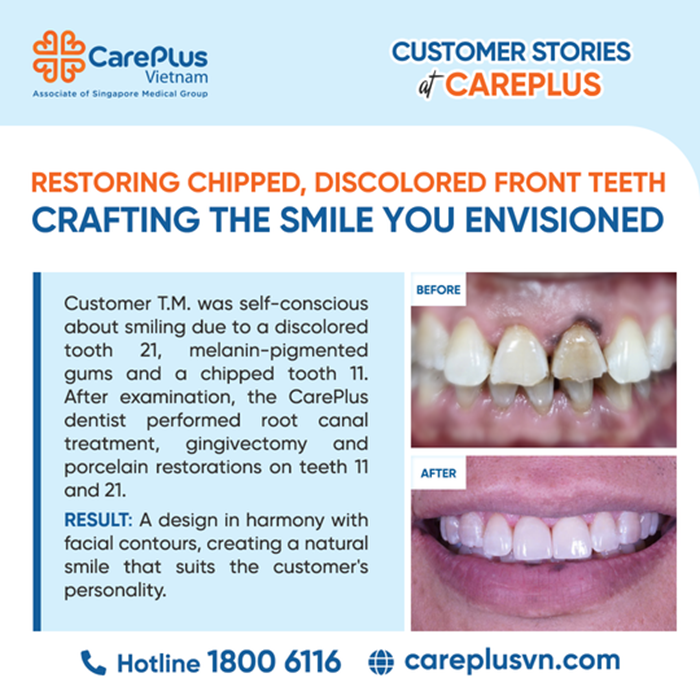 RESTORING CHIPPED, DISCOLORED FRONT TEETH - CRAFTING THE SMILE YOU ENVISIONED  