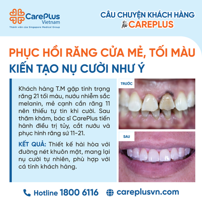  PHỤC HỒI RĂNG CỬA MẺ, TỐI MÀU – KIẾN TẠO NỤ CƯỜI NHƯ Ý 