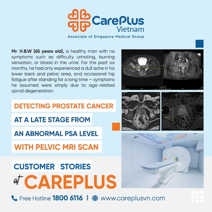 DETECTING PROSTATE CANCER​  AT A LATE STAGE FROM AN ABNORMAL PSA LEVEL​ WITH PELVIC MRI SCAN AT CAREPLUS​