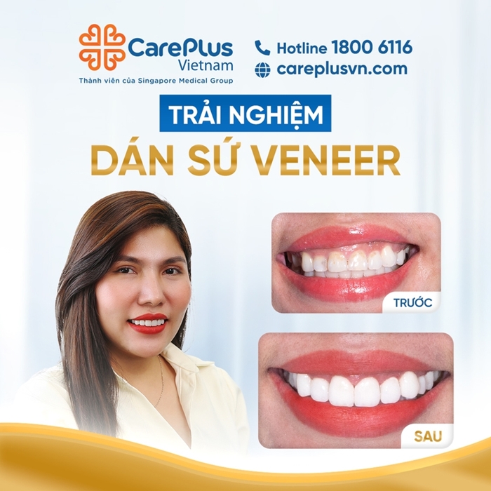 TRẢI NGHIỆM DÁN SỨ VENEER - SỞ HỮU NỤ CƯỜI HOÀN HẢO TẠI CAREPLUS
