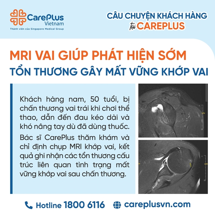 GIÁ TRỊ CỦA MRI TRONG ĐÁNH GIÁ TOÀN DIỆN MẤT VỮNG KHỚP VAI SAU CHẤN THƯƠNG 