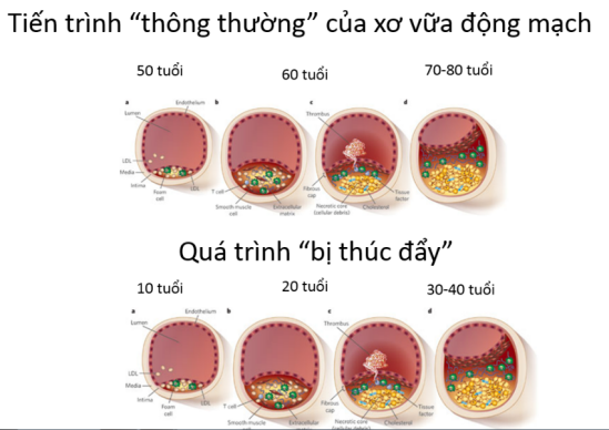 Tiến trình thúc đẩy xơ vữa động mạch ở trẻ em bị béo phì