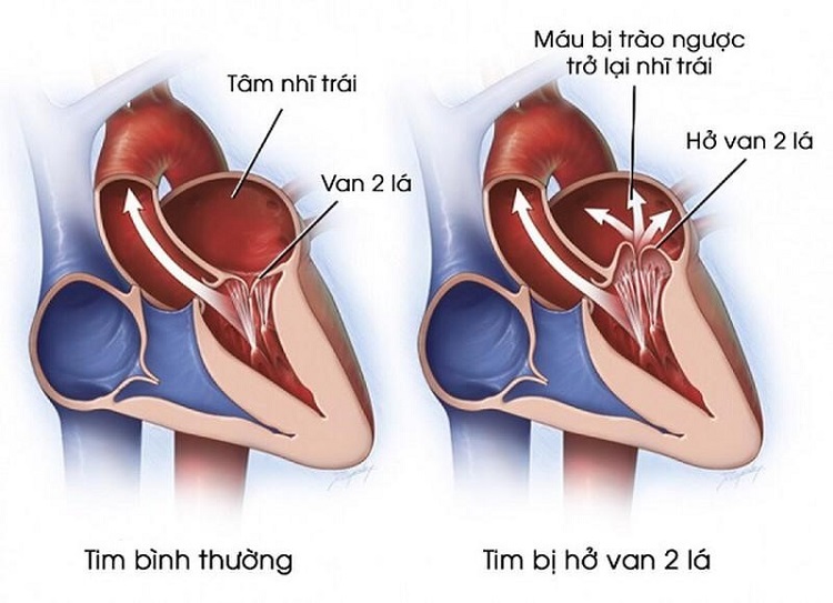 bệnh hở van tim