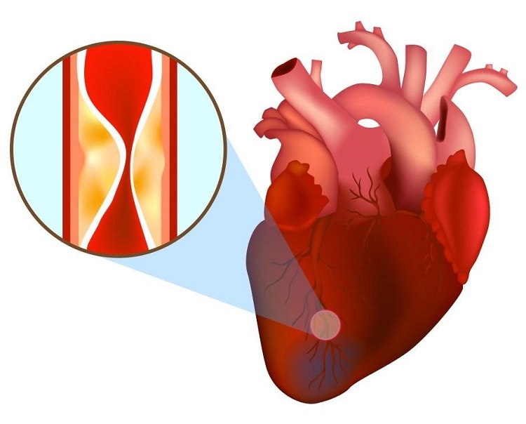 Bệnh nhồi máu cơ tim 