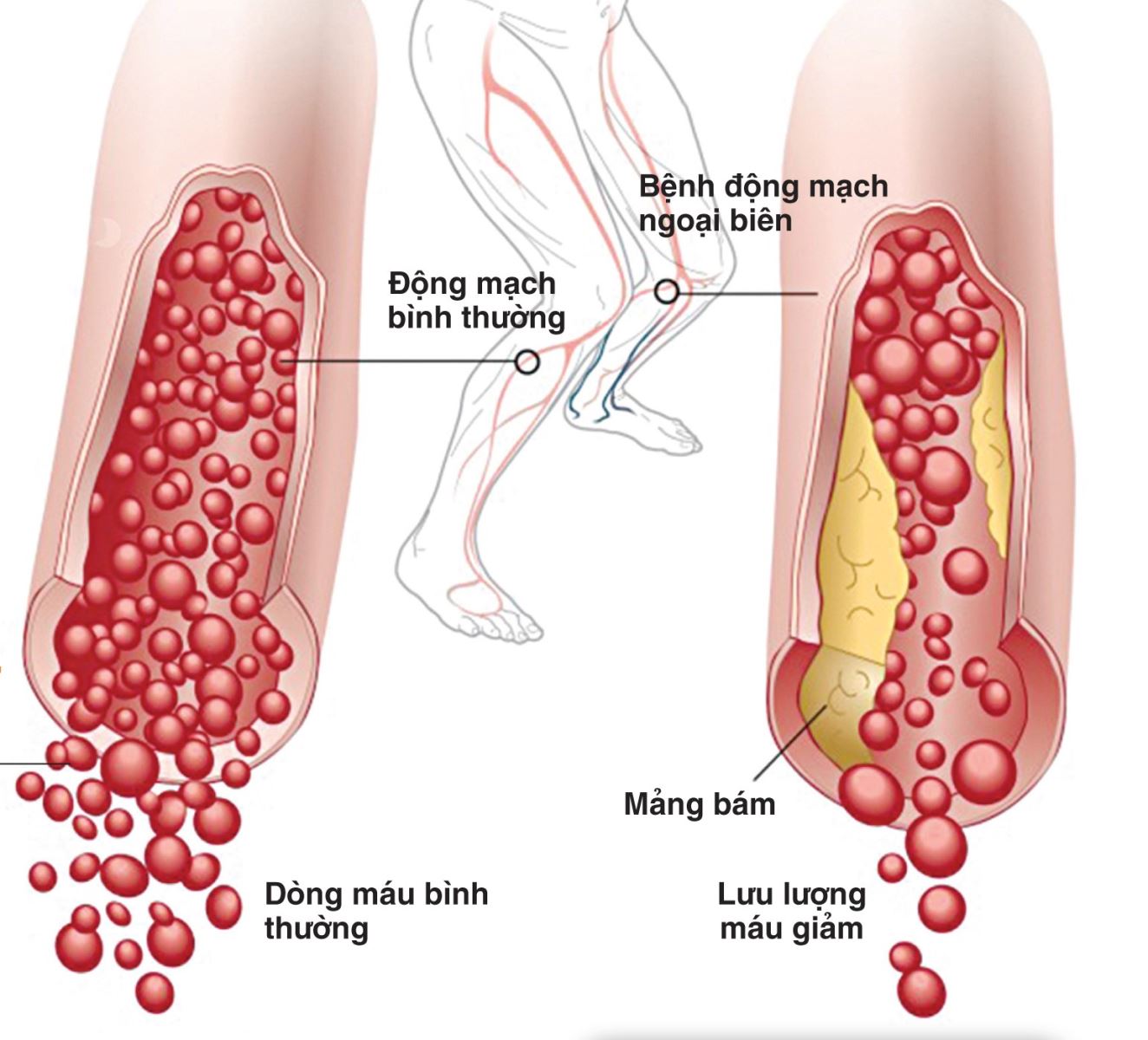 các bệnh tim mạch thường gặp và triệu chứng