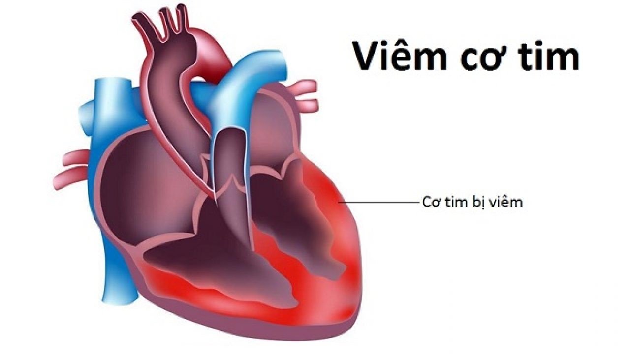 bệnh viêm cơ tim