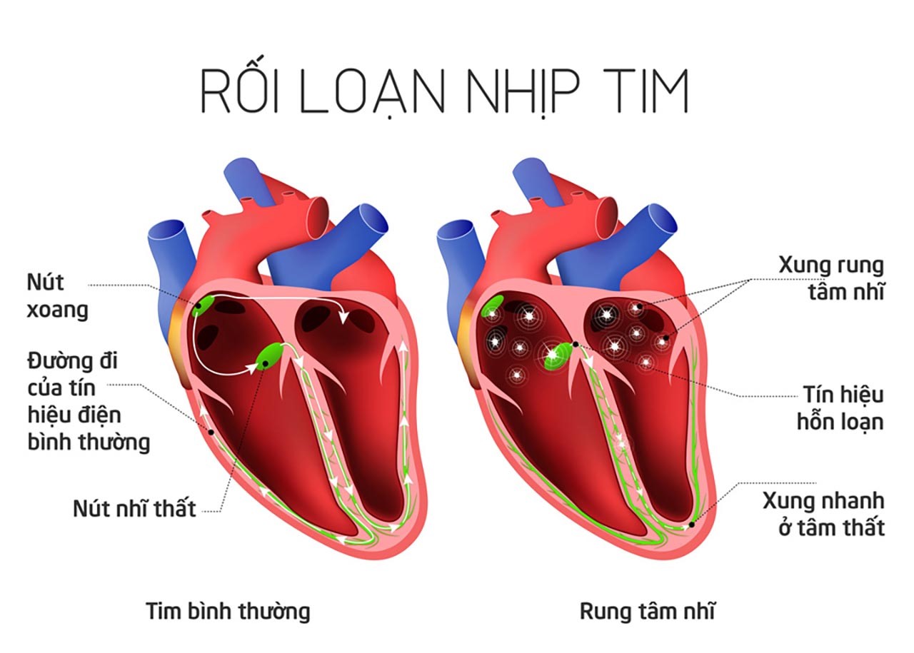 các bệnh tim mạch thường  gặp và triệu chứng