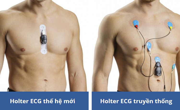 ecg la gi