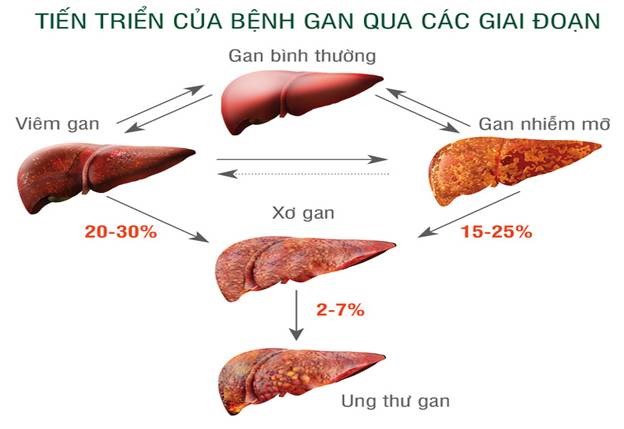 Gan nhiễm mỡ: dấu hiệu nhận biết sớm nhất và cách điều trị