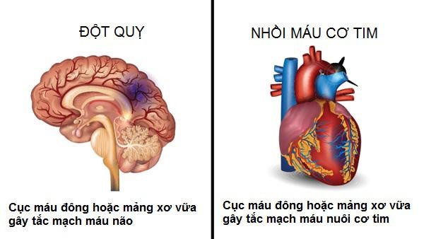 Phân biệt đột quỵ và nhồi máu cơ tim