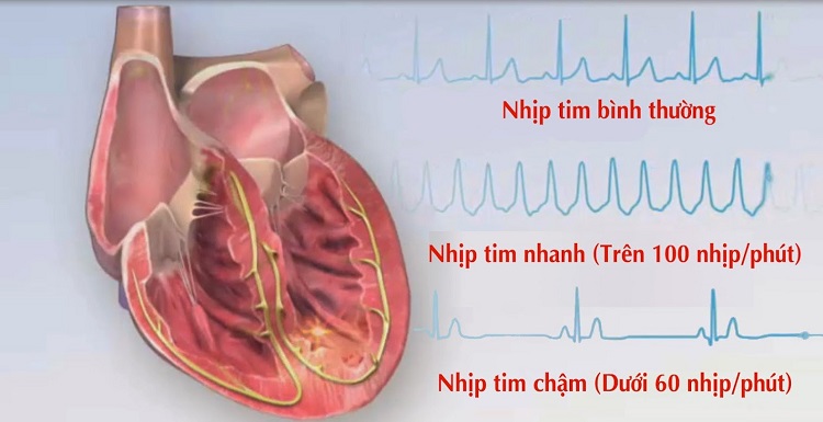 bệnh rối loạn nhịp tim