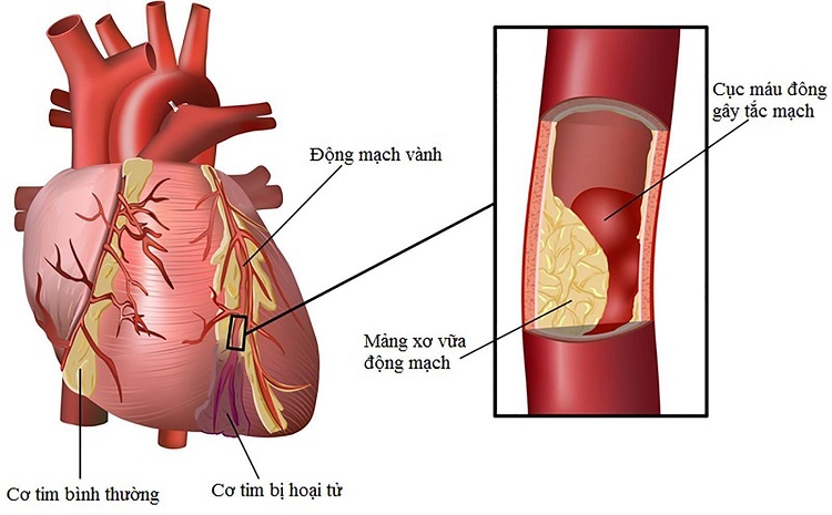 thiếu máu cơ tim